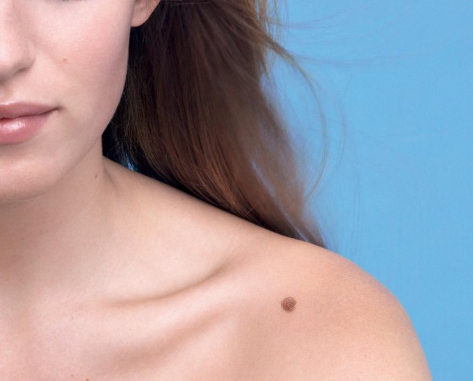 Симптомы ранней стадии рака кожи, о которых необходимо знать