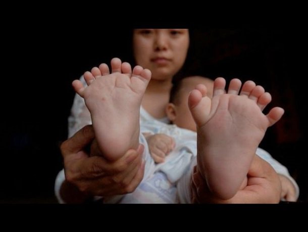 В Китае родился малыш с четырьмя ладонями