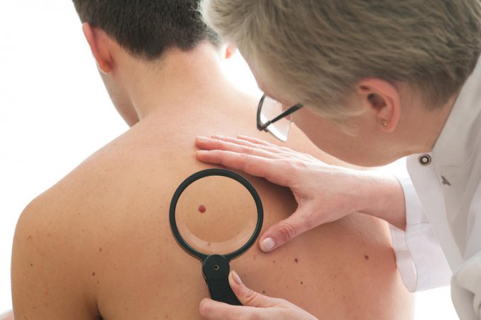 Как распознать рак кожи на начальной стадии