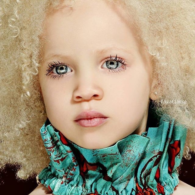 Эта малышка прославилась на весь мир уникальным цветом кожи. Фото