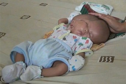 В Индонезии родился ребенок с двумя лицами. Видео