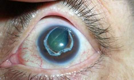 Медики розказали про можливі причини виникнення глаукоми