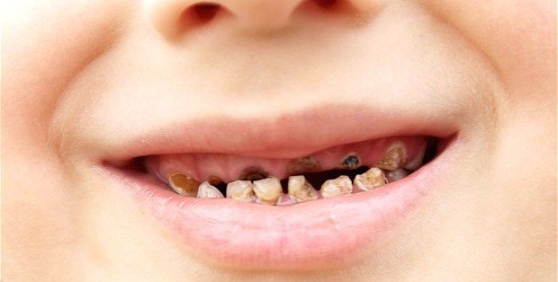Медики розповіли, як зберегти зуби дітей