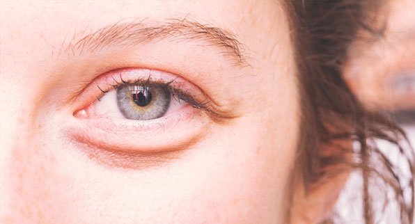 Фахівці розповіли, як зберегти молодість шкіри навколо очей